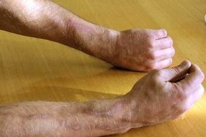 Флебит (воспаление) вены на руке: лечение