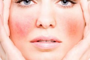 Купероз на лице: лечение (препараты), причины, симптомы