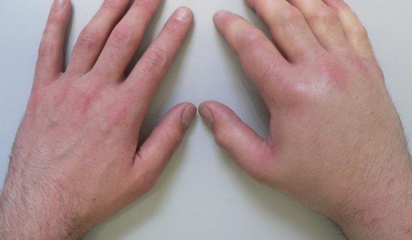 Лимфостаз руки: лечение (диеты, народные методы), причины, диагностика