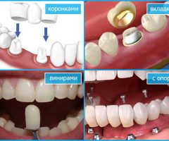 Зубное протезирование: какие виды протезов и в каких случаях