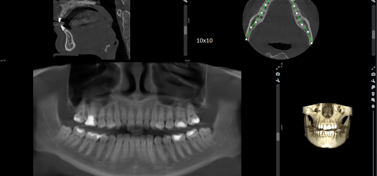 Томография зубов, придаточных пазух носа и челюстно-лицевой области