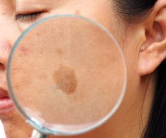 Что такое пигментация кожи и ее причины