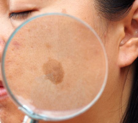 Что такое пигментация кожи и ее причины