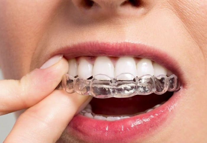 Зубные брекеты: отзывы пациентов