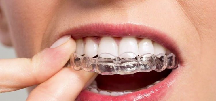 Зубные брекеты: отзывы пациентов