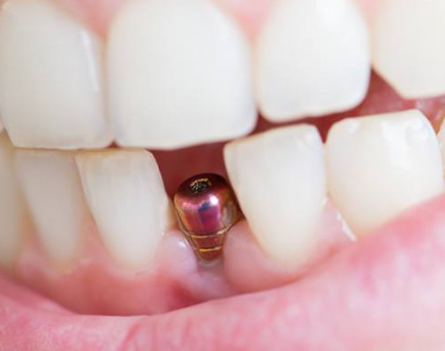 Имплантация зубов и ее преимущества