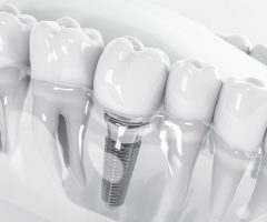 Современная имплантация зубов